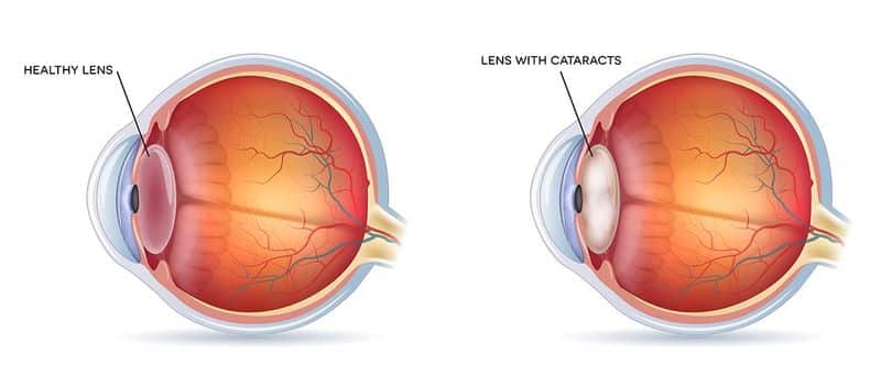 Chart Illustrating a Healthy Lens vs One With a Cataract