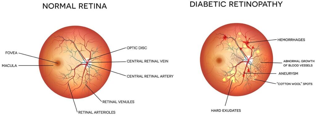Chart Illustrating a Normal Retina Compared to One Experiencing Diabetic Retinopathy