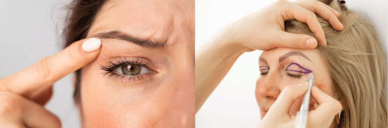 Understanding Eyelid Surgery at Sweeney Eye Associates