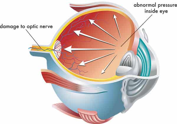 Chart Illustrating How Glaucoma Affects an Eye